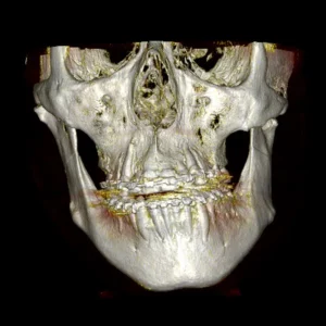 Asimetría facial con hiperplasia condílea