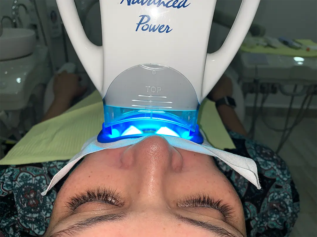 Blanqueamiento dental
