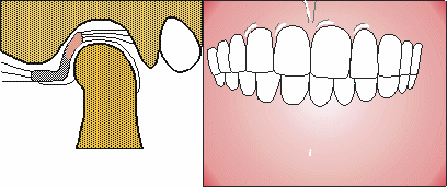 Disfunción de articulación Temporomandibular