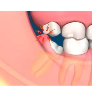 Molar impactado