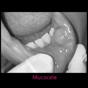 Mucocele