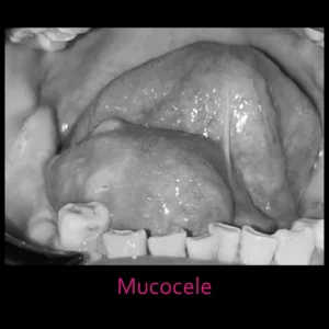 Mucocele