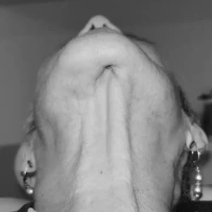 Osteomielitis y osteonecrosis de los maxilares