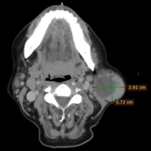 Patología de glándulas salivales