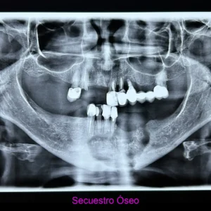 Secuestro Óseo