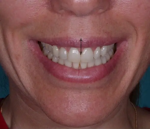 Sonrisa gingival - después