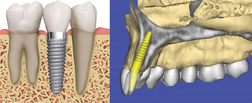 Implantología Dental