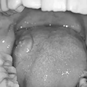 Lesiones en la lengua