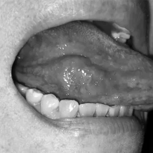 Lesiones en la lengua