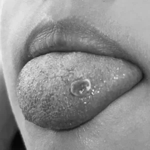 Lesiones en la lengua